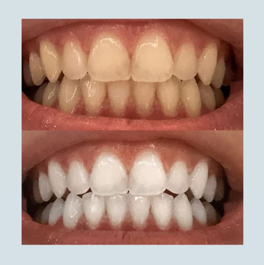 Whitening Strips – 2 boxes