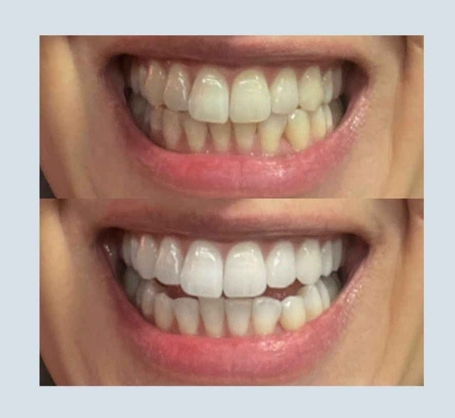 Whitening Kit - Whitening strips + Colour correcting serum